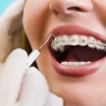 Benefits of Installing Braces